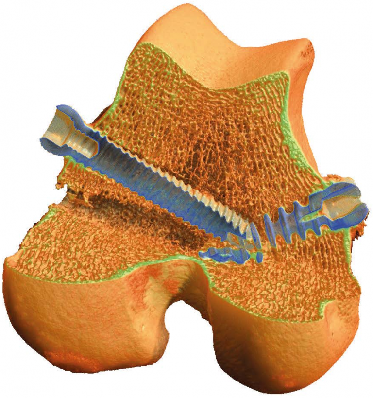 Rjl Microscanner Osseointegration von metallischen Implantaten artefaktfrei abgebildet ...